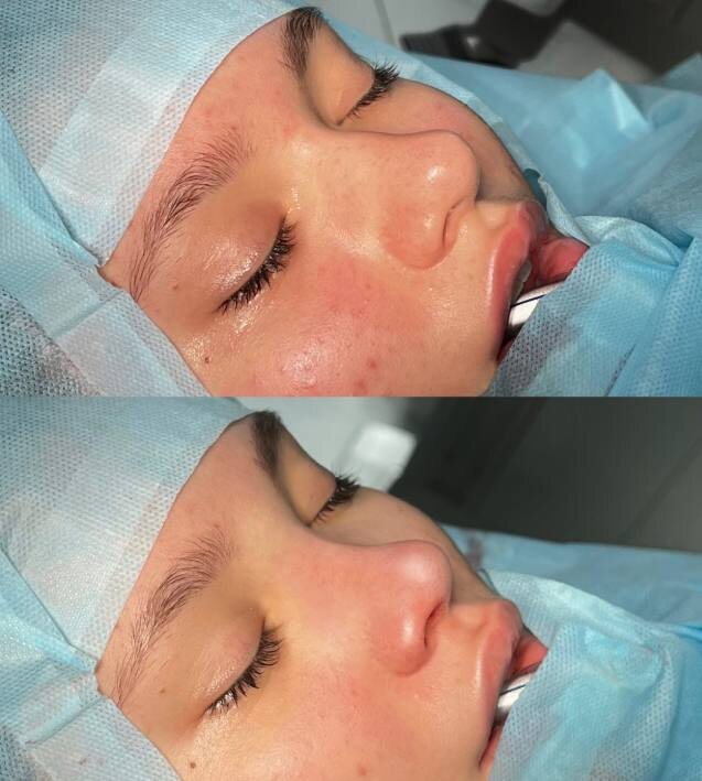 Нос Полины до и после. Социальные сети