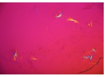 Кристаллы моноурата натрия в крови. 