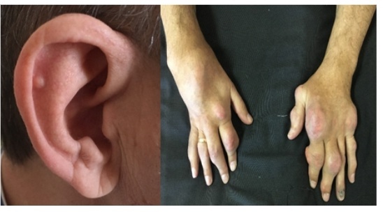 Проявления при хронической подагре - тофусы