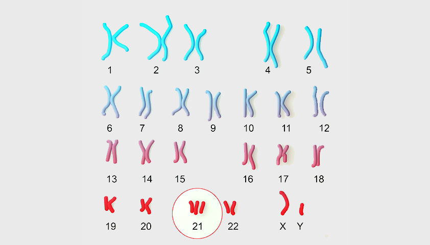 Хромосомы больного синдромом Дауна