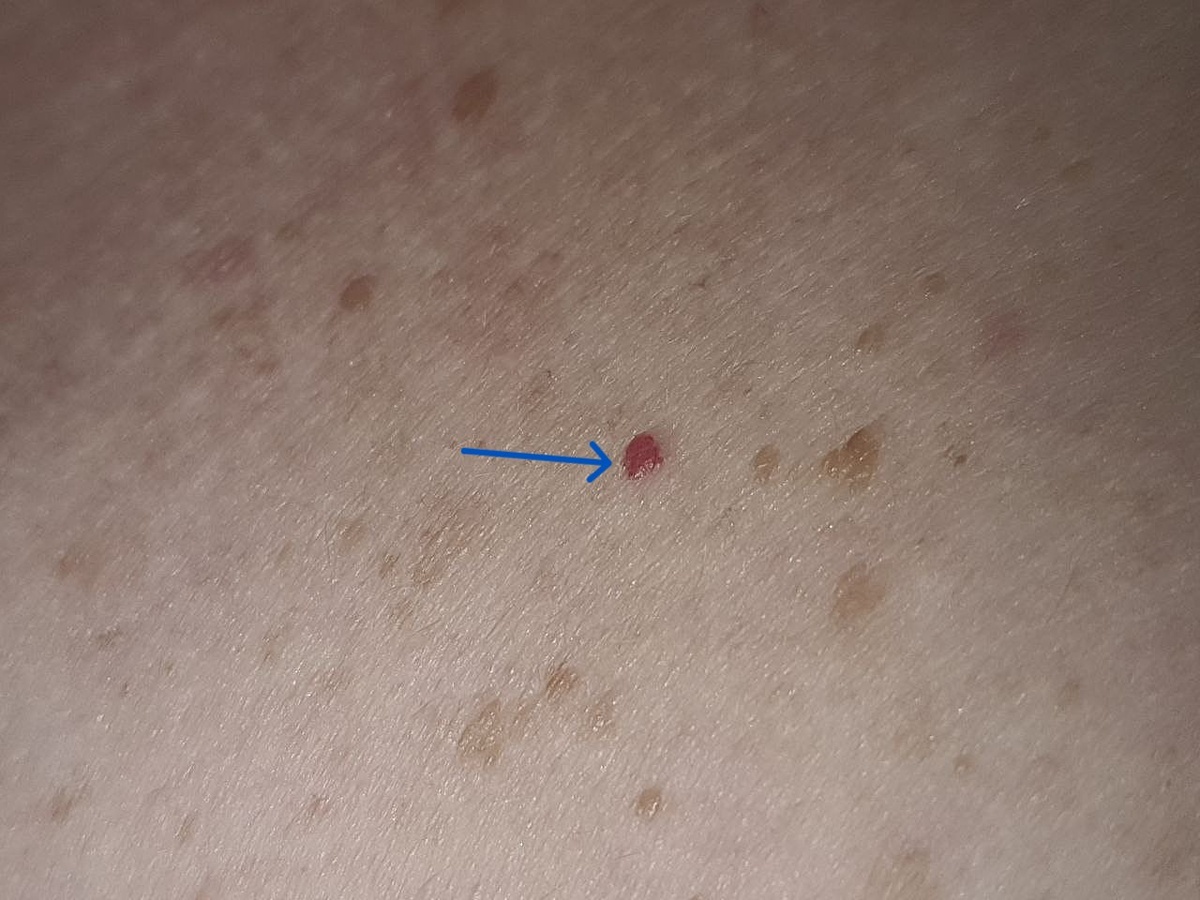 Фото из личного архива. Одиночная вишневая ангиома передней брюшной стенки.