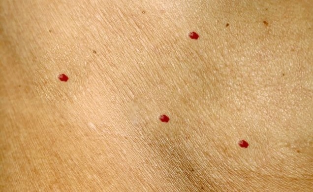 Фото из личного архива. Множественные вишневые ангиомы передней поверхности грудной клетки.