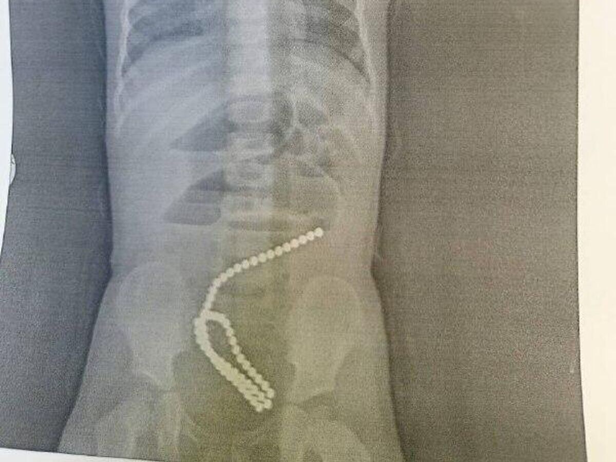    Детские хирурги Городской больницы № 7 Комсомольска-на-Амуре спасли ребенка, проглотившего магниты© Фото : Министерство здравоохранения Хабаровского края