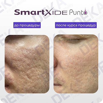 Результат лазерной шлифовки на аппарате SmartXide Punto