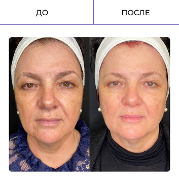 Результат коррекции пигментации на аппарате Red Touch