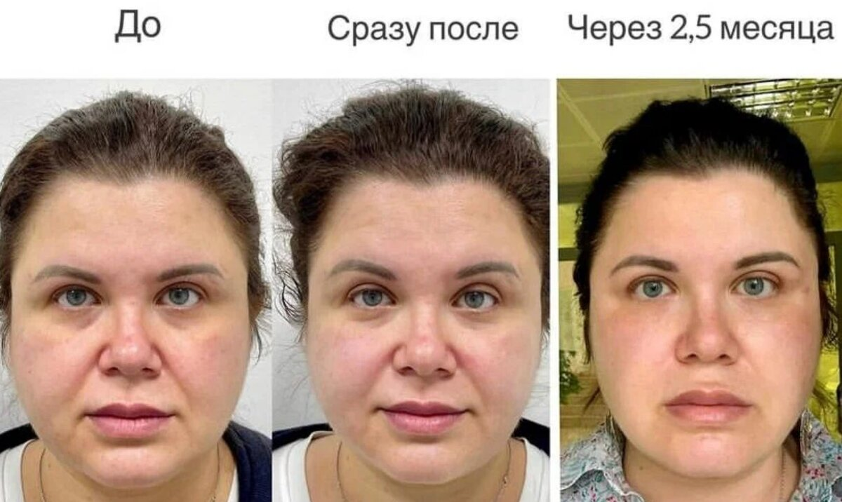 SMAS-лифтинг на аппарате Liftera. Фото предоставлено Д.Р. Гришкяном. Имеются противопоказания, требуется консультация специалиста