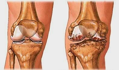 Здоровый сустав слева. Артроз коленного сустава справа. https://pin.it/7IaV4bqP3