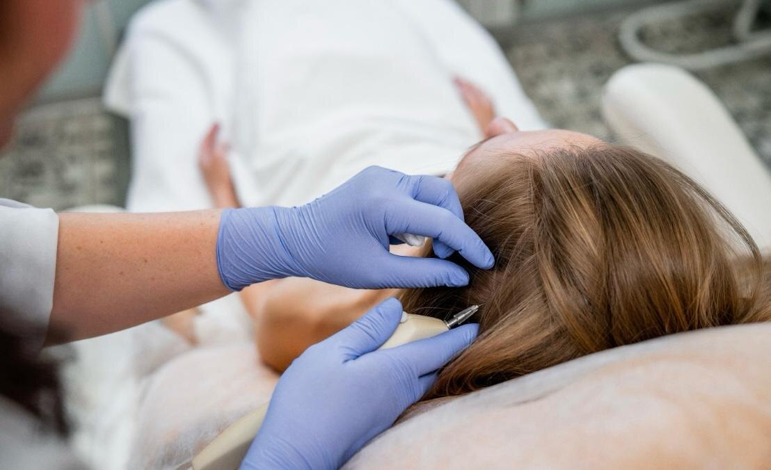 Стимулирование роста новых волос с помощью карбокситерапии