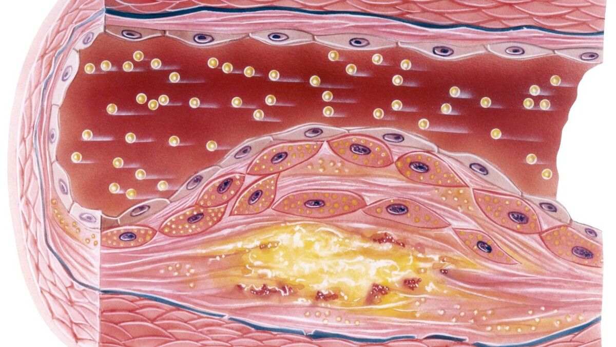 Статины: риск или спасение? Врач отвечает на главные вопросы о лекарствах для сердца