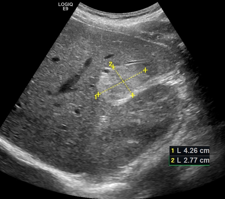 Рис. 01. Кавернозная гемангиома печени.
