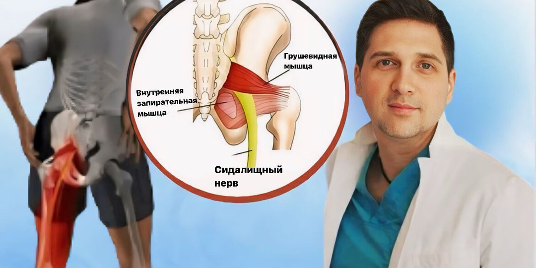 Как снять боль при защемлении седалищного нерва: упражнения, которые спасут вас от мучений
