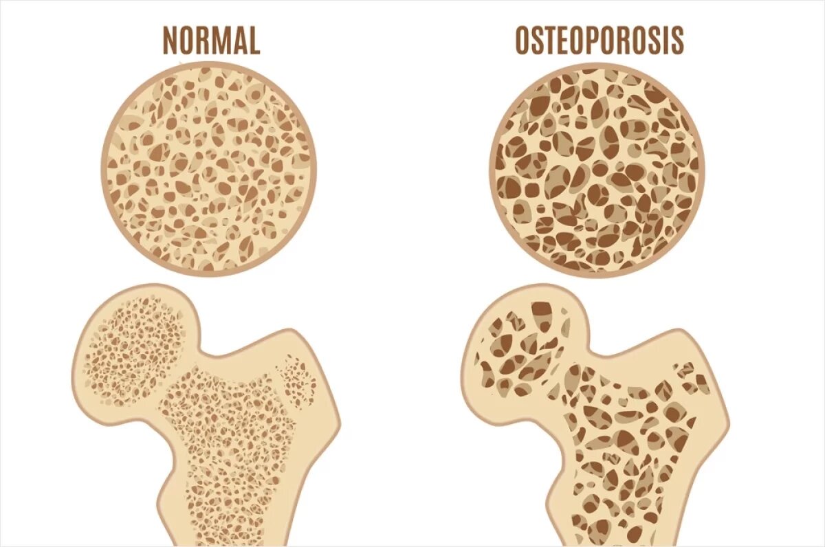    Без переломов.