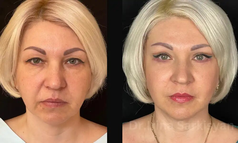 
Можно ли исправить неудачную блефаропластику?