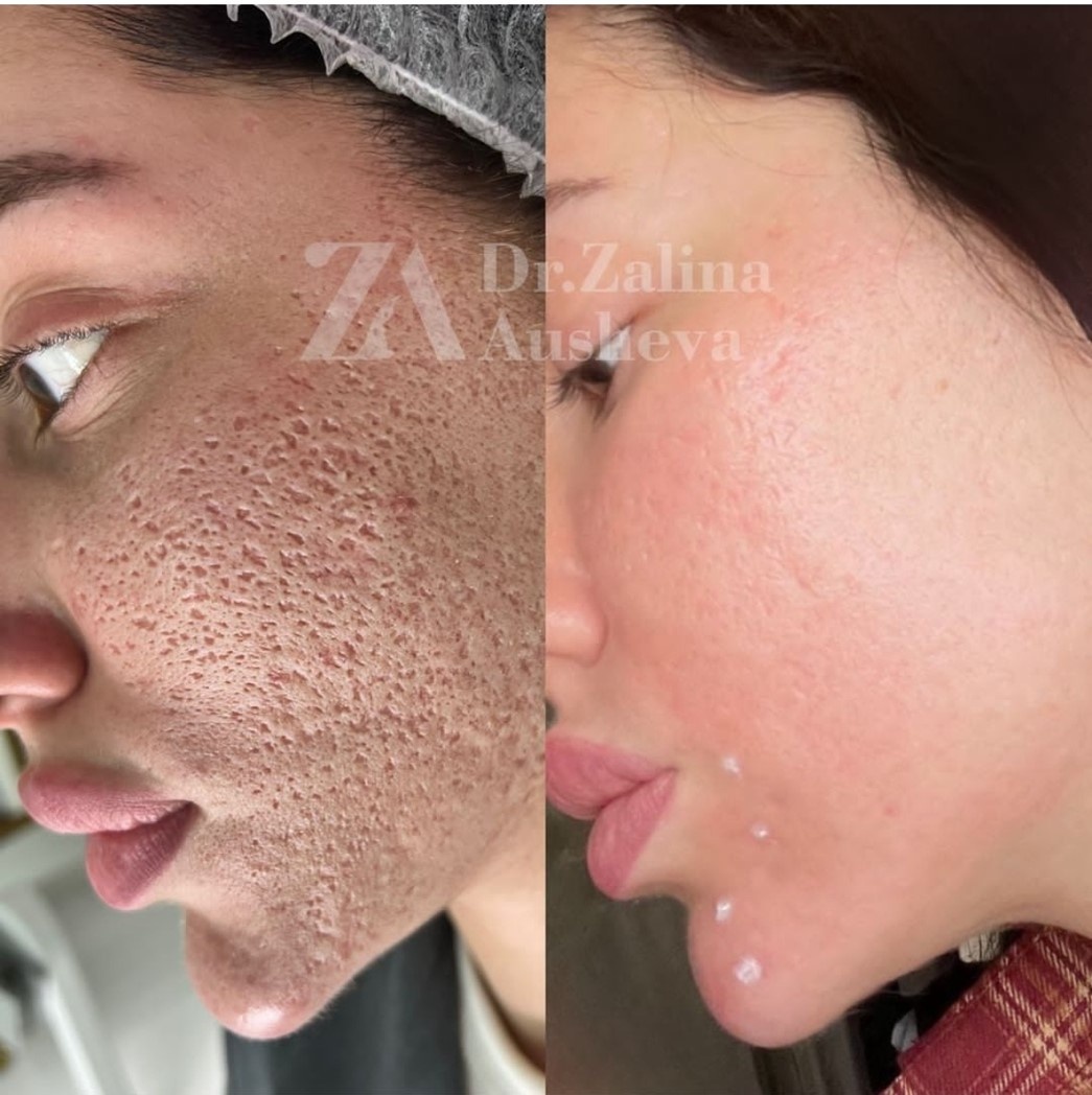 Работа с многолетними рубцами

Результат достигнут за 1 процедуру:
лазерная абляция + ARESSAGE Face ReFactors

Из клинической практики 
Аушевой Залины Абуезитовны, г. Москва

