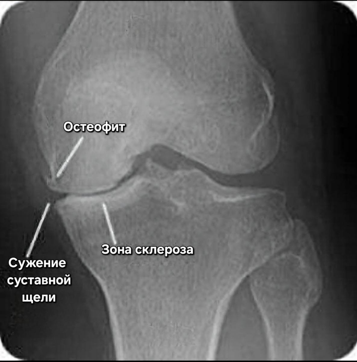 Рентгенологические признаки артроза коленного сустава https://pin.it/2JjBd8yLu