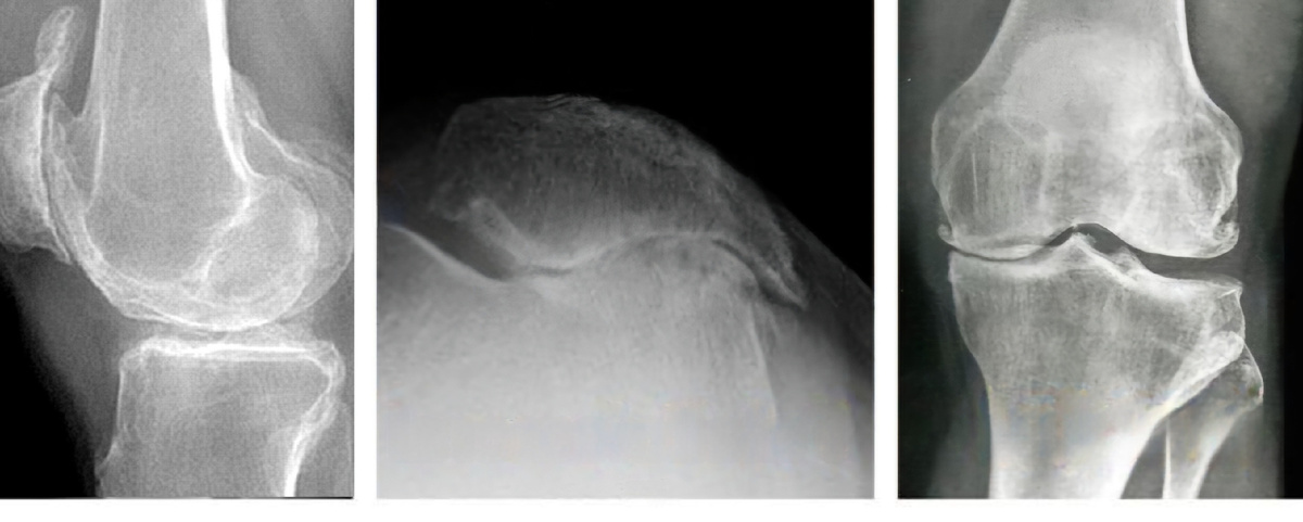 Рентгенография коленного сустава в 3х проекциях. Показаны деформирующие изменения в суставе. 