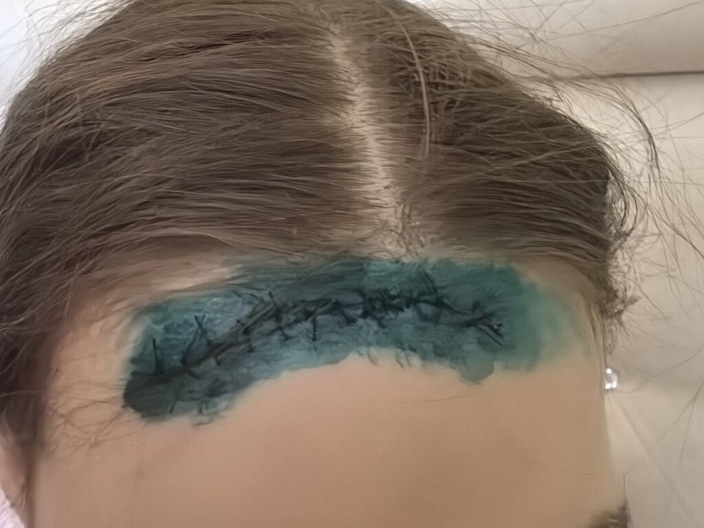    В Оренбурге 7-летняя девочка «крутила сальто» в сухом бассейне на глазах у взрослых и получила 15 швов. Видео происшествия