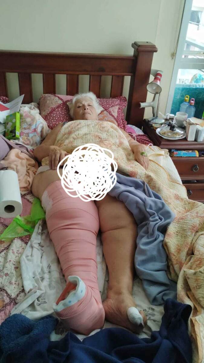 Правая нога за день увеличилась в объемах в два раза. 