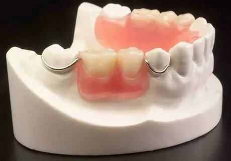 Проволочные кламмеры