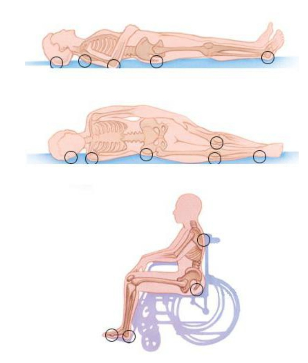 Места образования пролежней. Фото из свободных источников