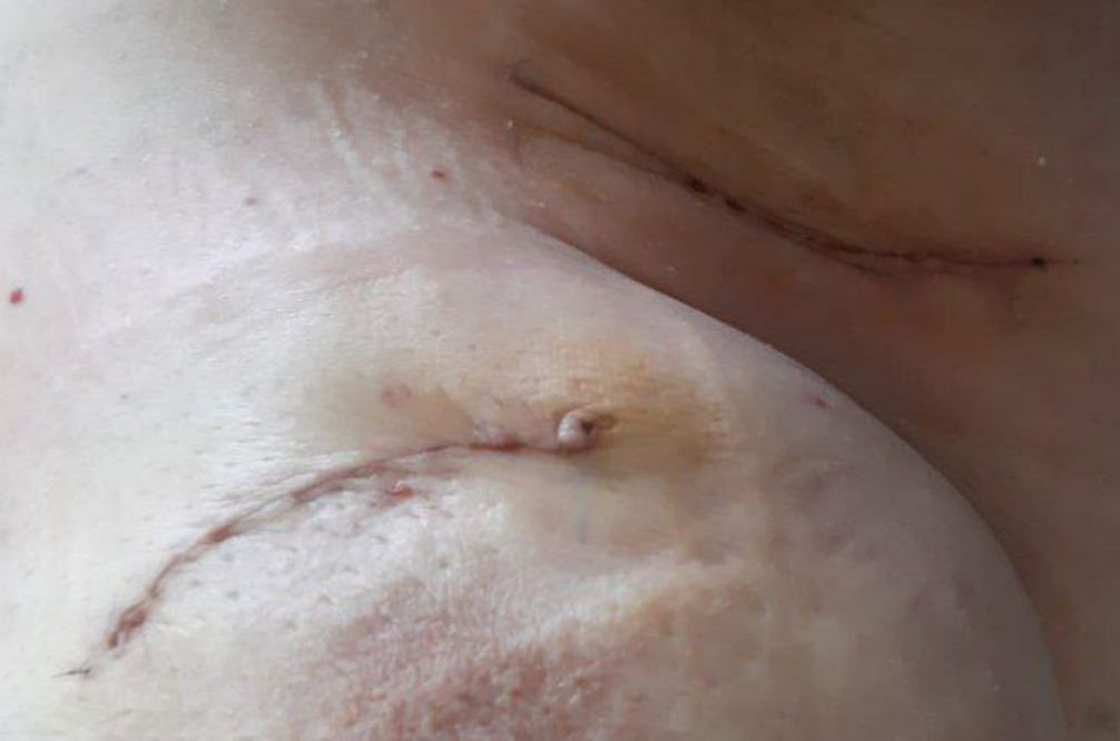 лишь небольшиерубцы напоминают о заболевании. Вскоре они станут незаметными. 