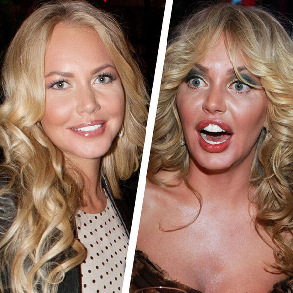 Пример неудачного увеличения губ