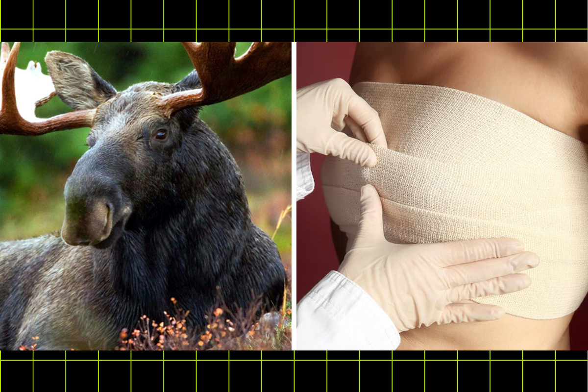     У китаянки обнаружили ДНК животных после операции по увеличению груди за 20 млн рублей