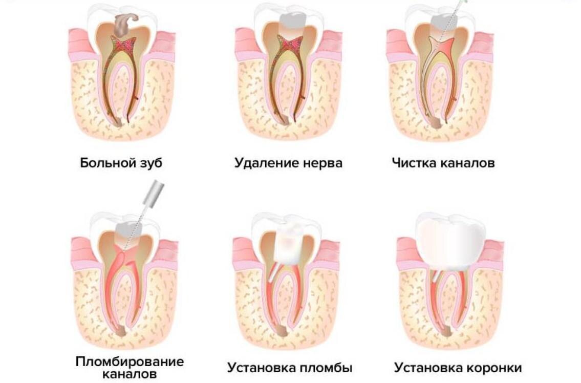 Классическая схема лечения пульпита

