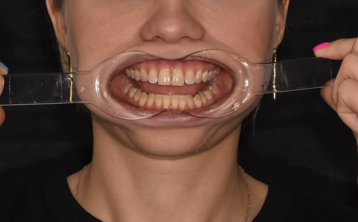 Фото нашей пациентки до ортодонтического лечения: из жалоб - скученность зубов на нижней челюсти. 