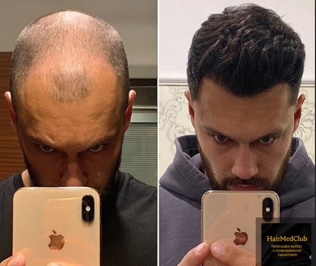 Пересадка волос в Стамбуле