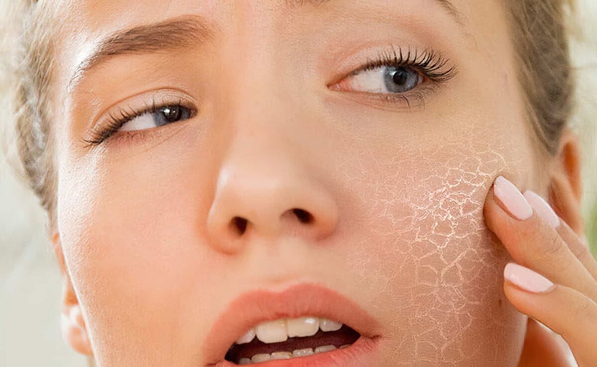 Как бороться с сухостью кожи: причины, уход, советы