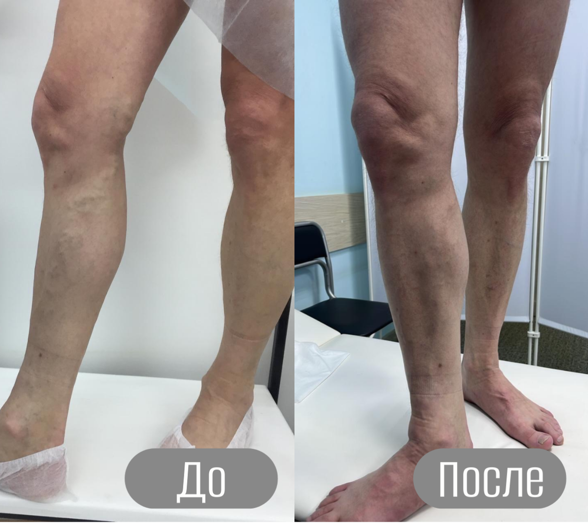 Как получить квоту на лечение варикоза по ОМС