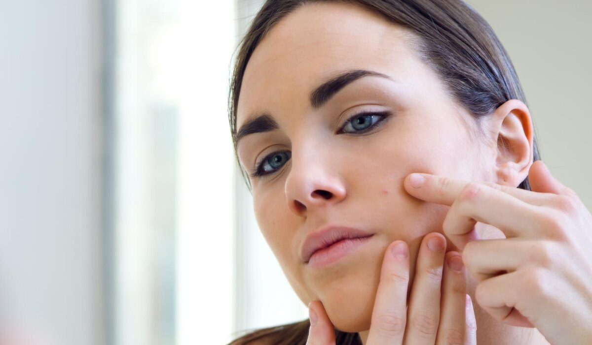     Ставим точку: 5 точечных способов борьбы с акне