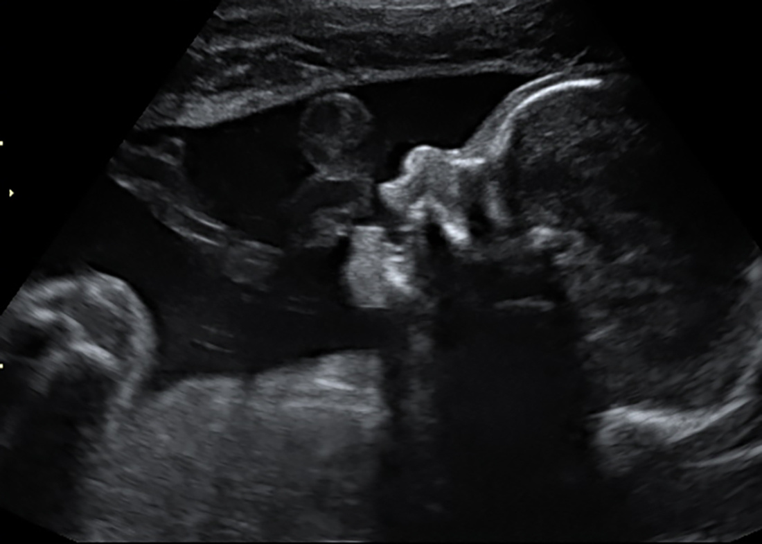 Юридически плод становится человеком, наделённым правами, с момента рождения, но многие не согласны с такой постановкой вопроса.