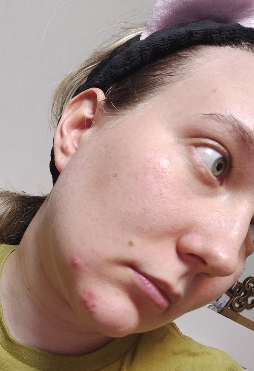 У меня такое на лице частое явление, но я научилась в целом доводить состояние до ремиссии (но иногда расслабляюсь и всё по новой). 