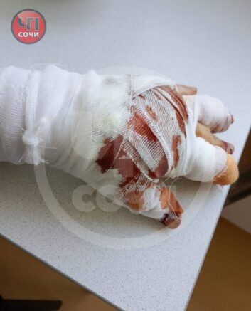    Искусанная рука пострадавшей женщины / t.me/chp_sochi