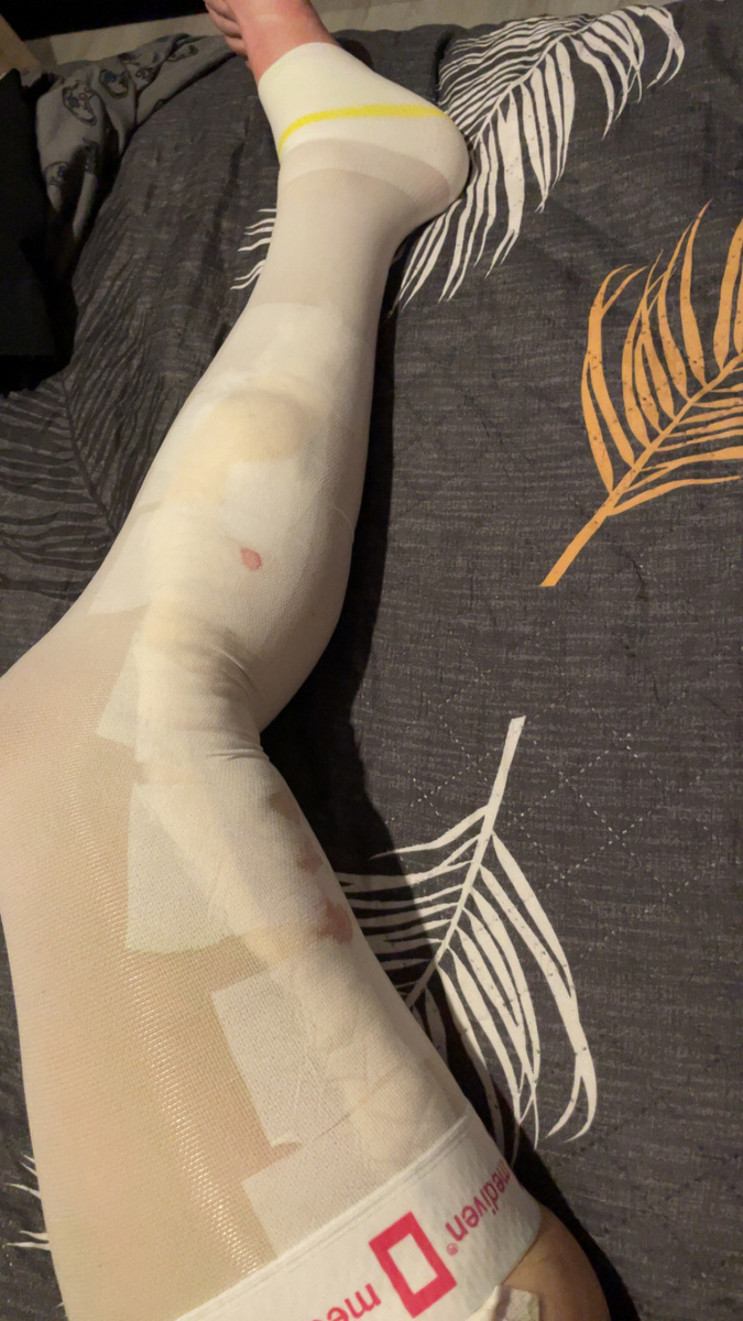 ЭВЛК (электронно-волновая лазерная коагуляция)+ 1 этап склеротерапии