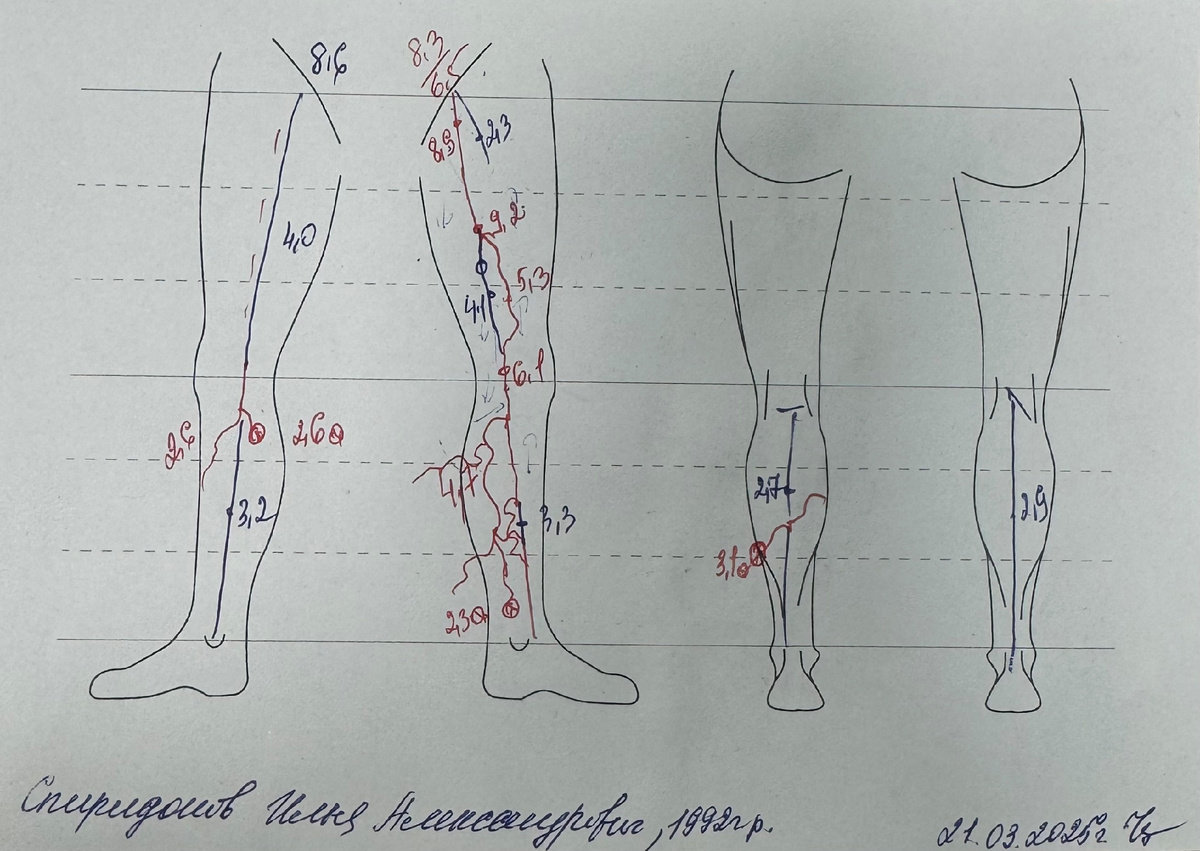 Схематично это выглядит вот так. Синие это глубокие задние вены, красные передние. В трёх местах увеличение размера вены, т.к. не работал один из клапанов, который должен был качать кровь дальше.