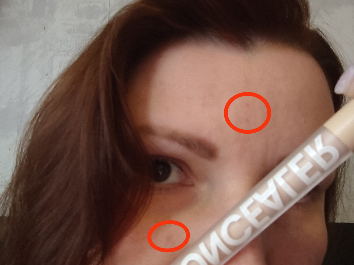 Мелкие синячки на лице после процедуры. Личное фото