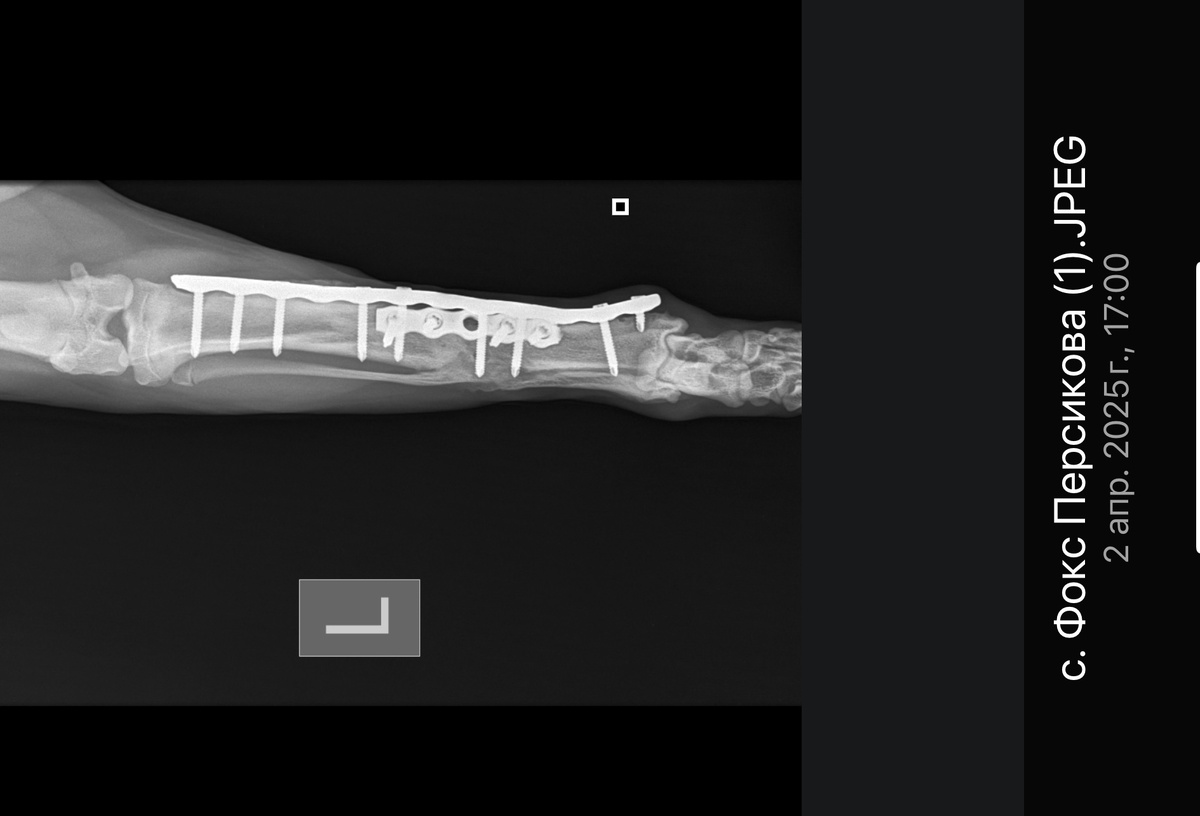 Перелом сросся, но оставят одну пластину для подстраховки и три винта 