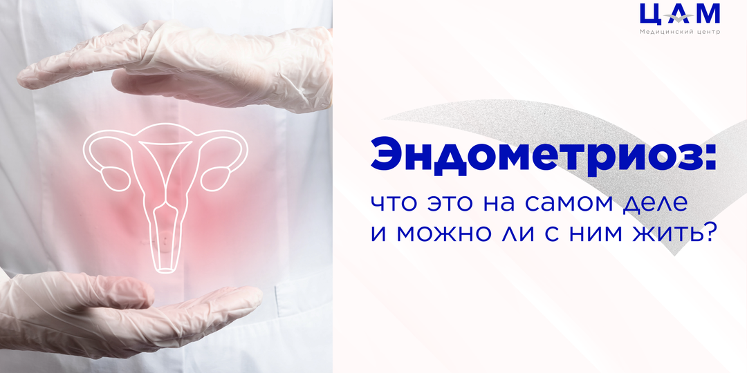 Эндометриоз: что это на самом деле и можно ли с ним жить?