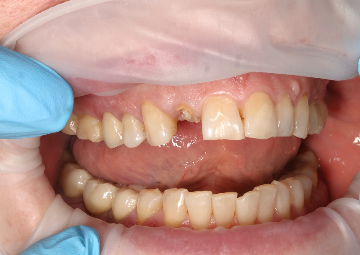 Корень 1.2 зуба требует принятия решения