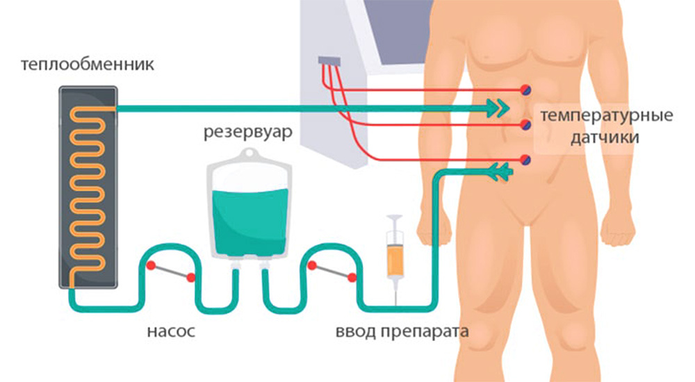 Методика проведения HIPEC