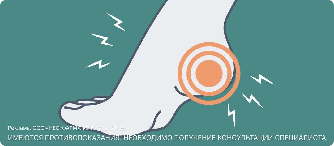 Пяточная шпора: причины, симптомы и лечение