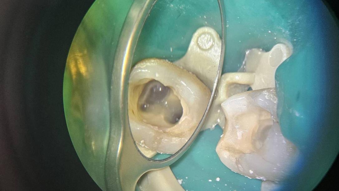 Зуб во время лечения под микроскопом