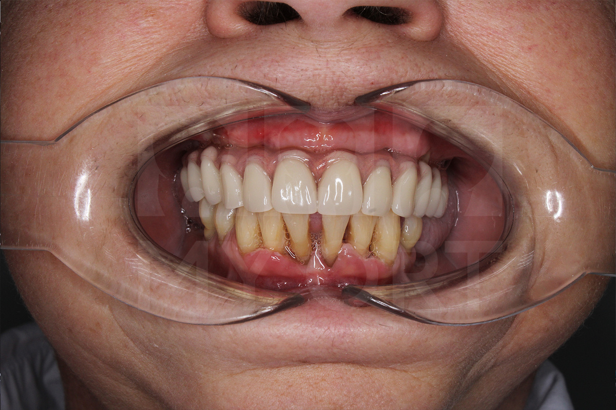 Состояние нижних зубов ДО 