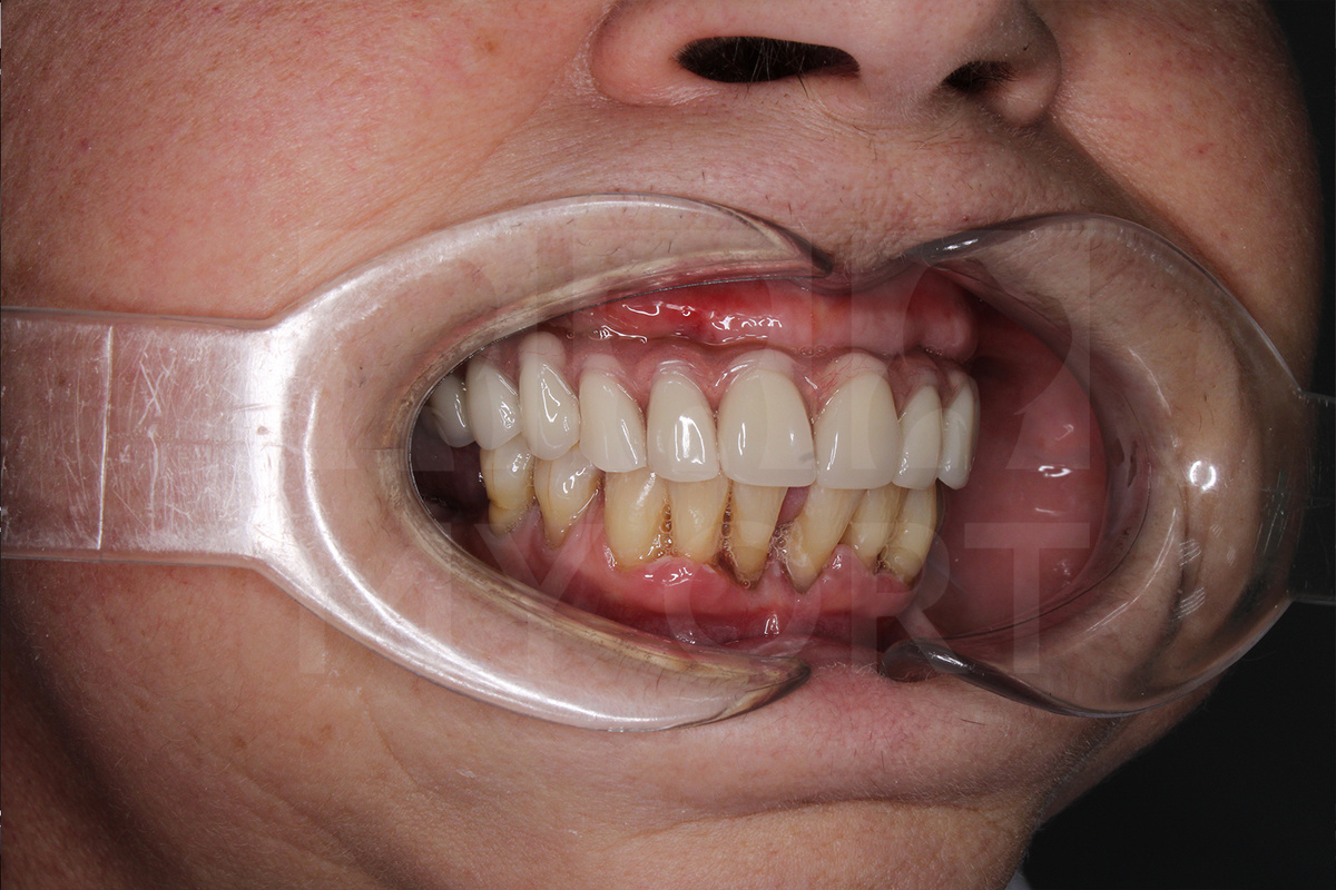 Состояние нижних зубов ДО 