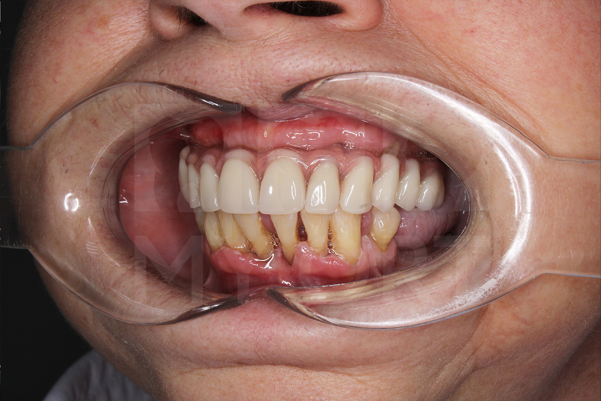 Состояние нижних зубов ДО 