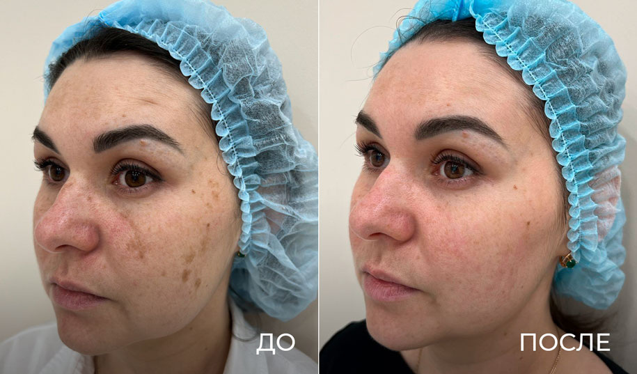 удаление пигментых пятен в клинике Скинмед. Результат за 1 посещение. Врач, Валеева Лилия Рамилевна