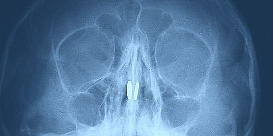    Игрушечные детали притянулись друг к другу через носовую перегородку, вызвав воспаление слизистой